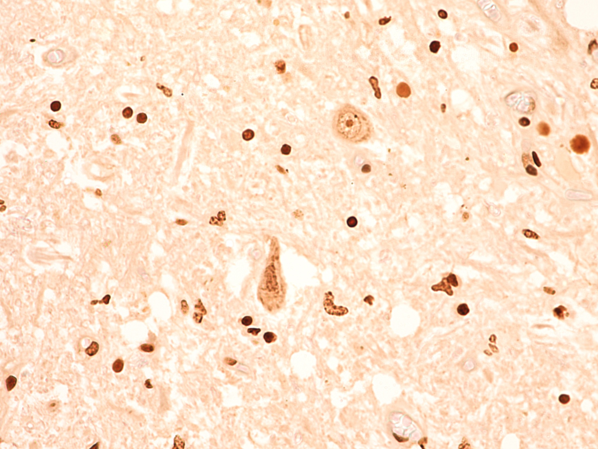 Aptamers for the early detection and monitoring of neurodegenerative diseases